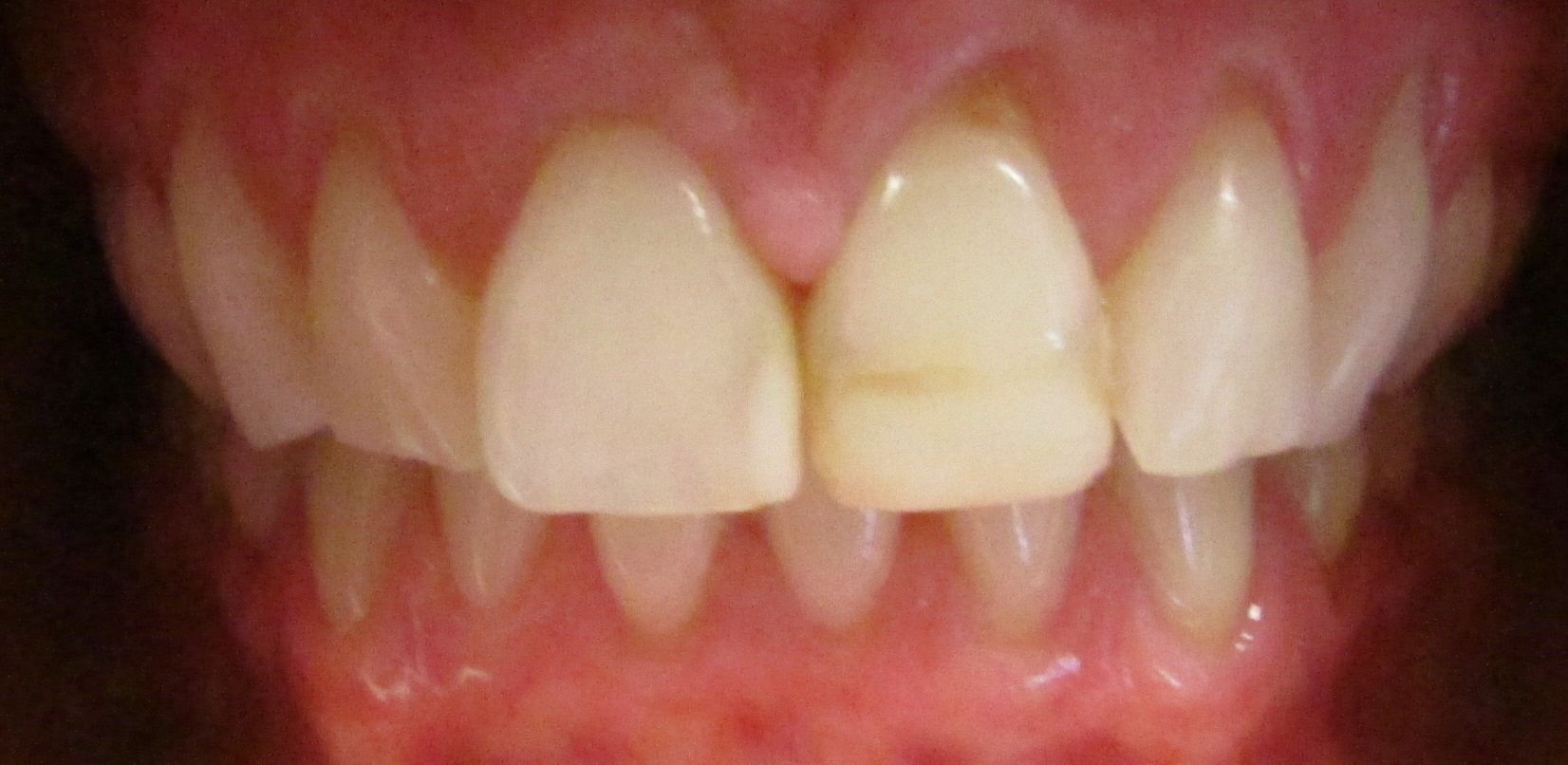 A close up of a person 's teeth with a black background.