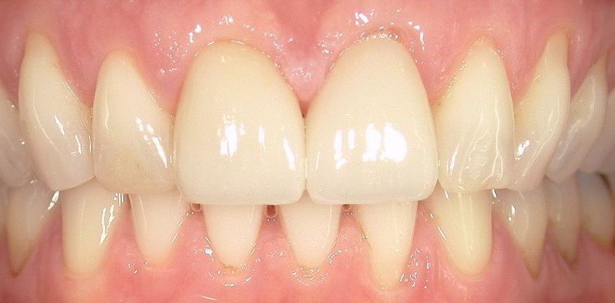 A close up of a person 's teeth with white teeth.
