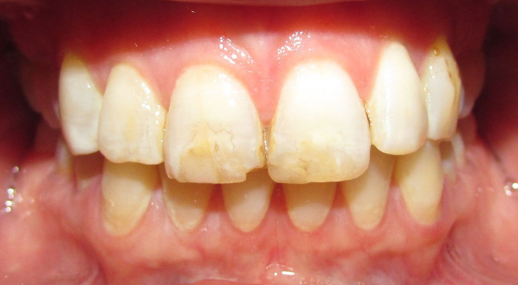 A close up of a person 's teeth with yellow spots on them.