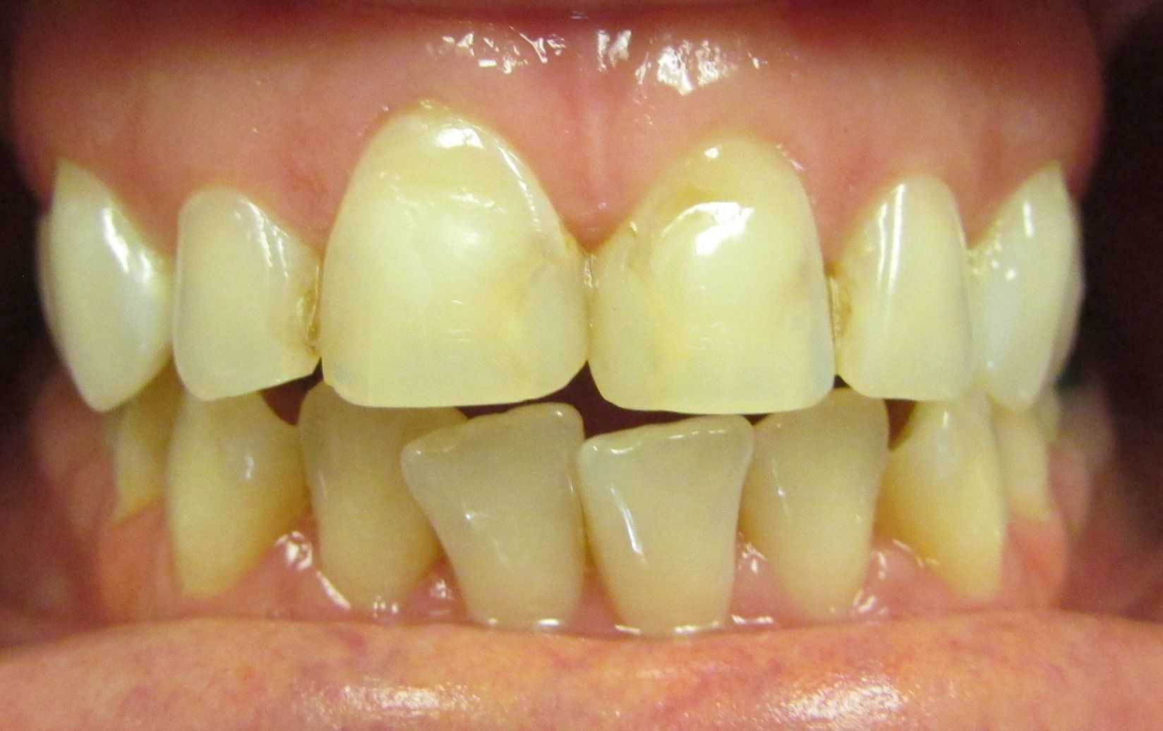 A close up of a person 's teeth with a broken tooth.