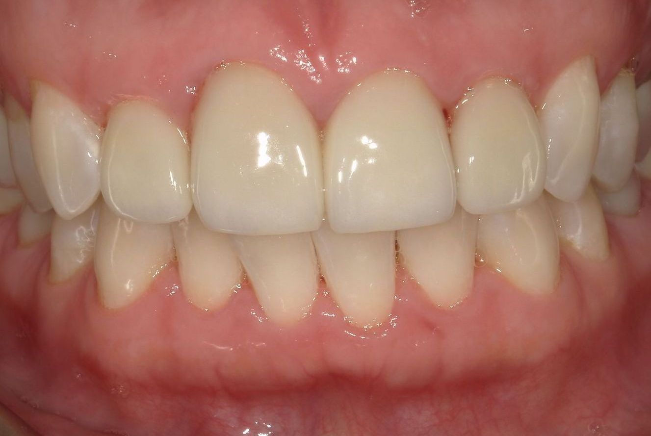 A close up of a person 's teeth with porcelain crowns.
