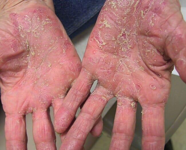 DR FCO JAVIER ROJAS ACOSTA - Vitíligo, caspa, seborrea