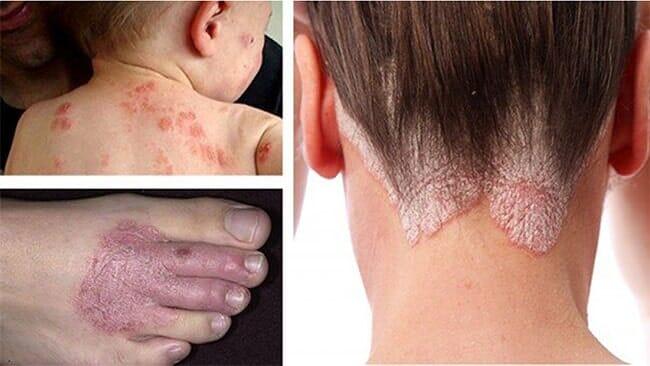 DR FCO JAVIER ROJAS ACOSTA - Cáncer en la piel