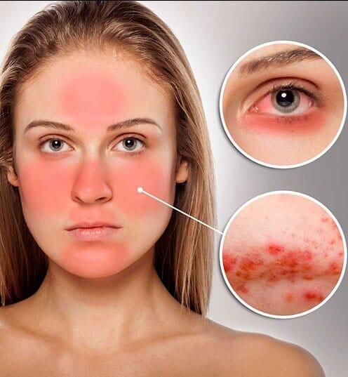 DR FCO JAVIER ROJAS ACOSTA - Constantes comezones