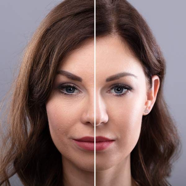 A before-and-after photo of a woman's face from advanced cosmetic treatments at Victory Medical Institute Transform Your Health, Renew Your Vitality, Serving Patients in Morris Plains, New Jersey, and Manhatta,n New York