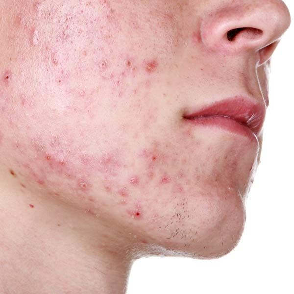 Close-up of a cheek and jawline with acne blemishes  caused by High Testosterone
