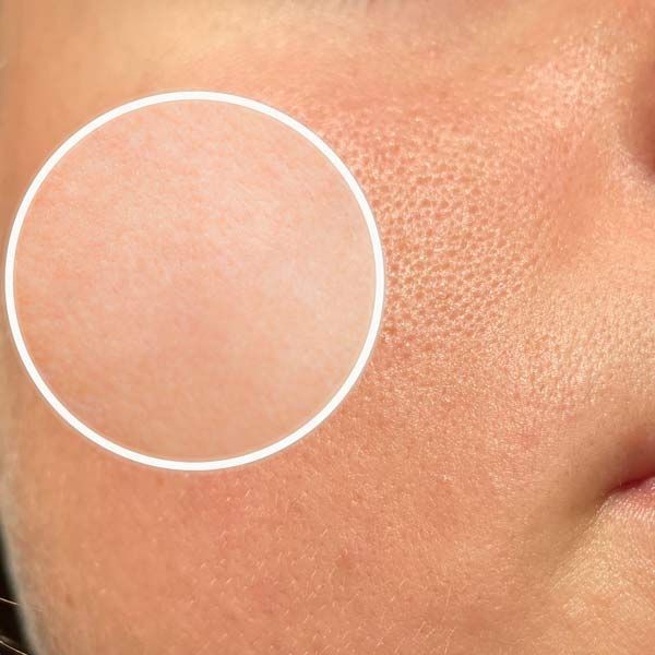 A close-up of a person's face with a white circle around it showing results of Skin Tightening Treatment with Morpheus8