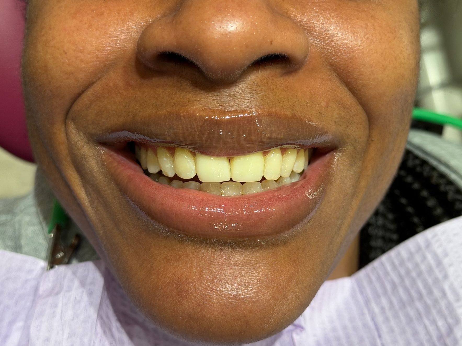 A close up of a man 's mouth with missing teeth.