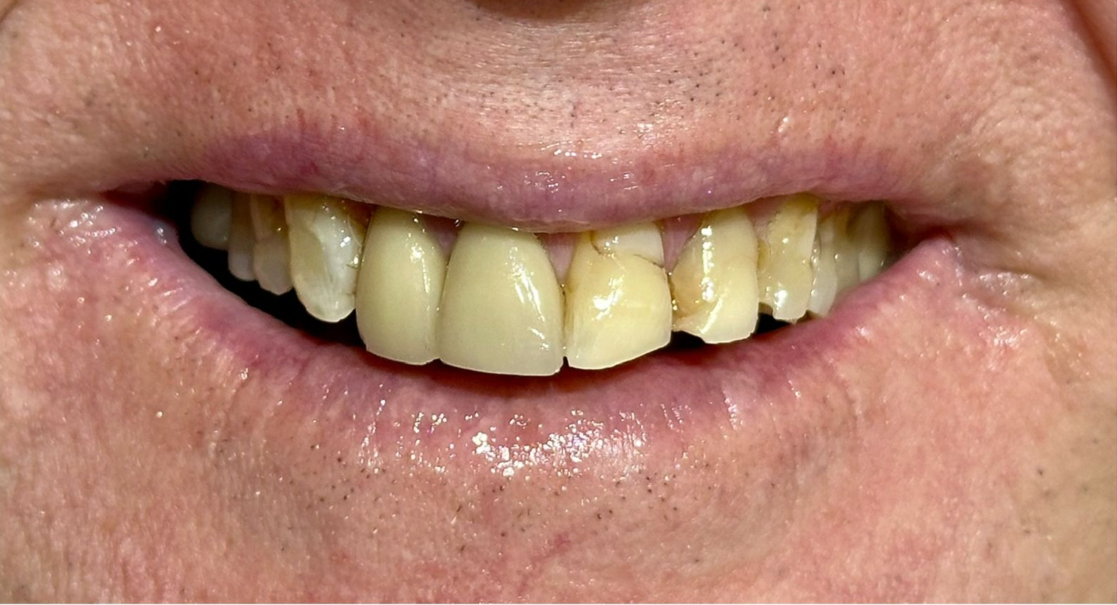 A close up of a man 's mouth with a missing tooth.