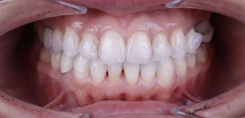 After smile
