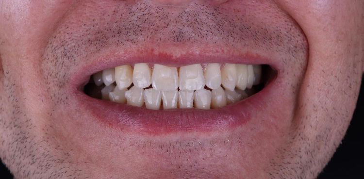 After smile