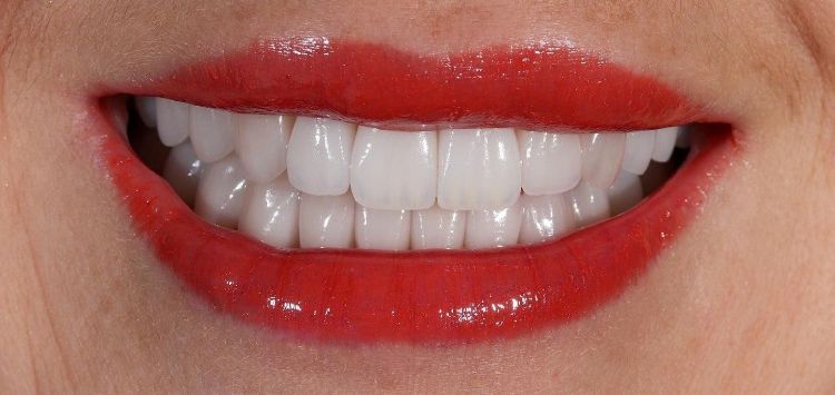 After smile