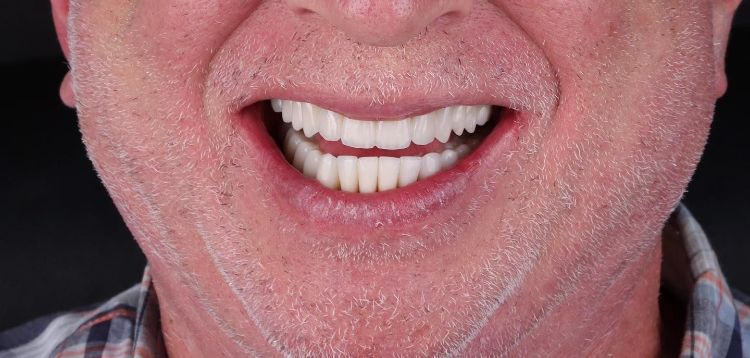 After smile