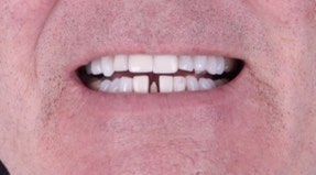 Before Smile