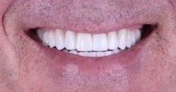 After smile