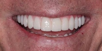 After smile