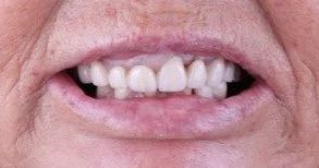 Before smile