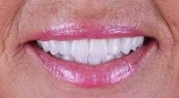After smile