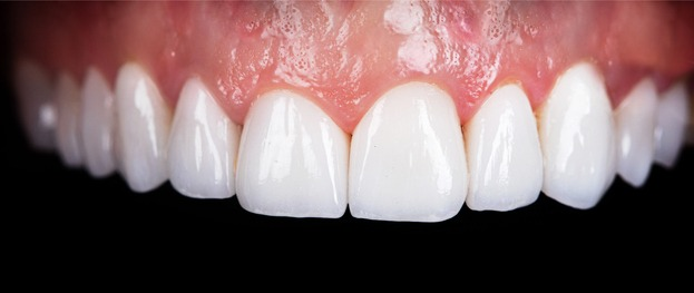 Close-up of bright white upper teeth and pink gums against a black background