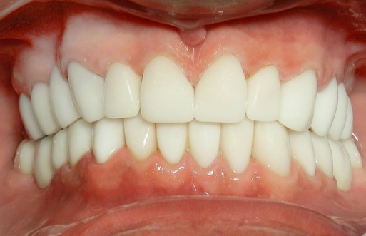 Close-up of artificial dentures with white teeth and pink gums in an open mouth