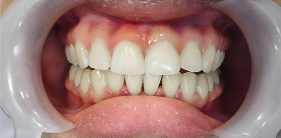 Close-up of a mouth with teeth held apart by a cheek retractor, showing upper and lower teeth and gums