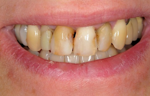 Close-up of a smiling mouth showing yellowed, uneven teeth with visible gaps and discoloration