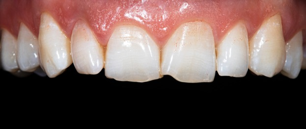 Close-up of upper front teeth with a noticeable gap between the central incisors