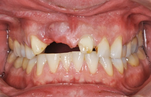 Close-up of damaged teeth and gums with a large gap in the upper front teeth