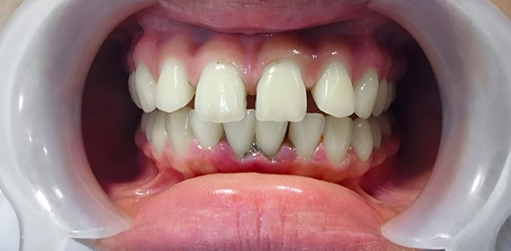 Close-up of teeth with visible crowding and misalignment inside a dental cheek retractor.