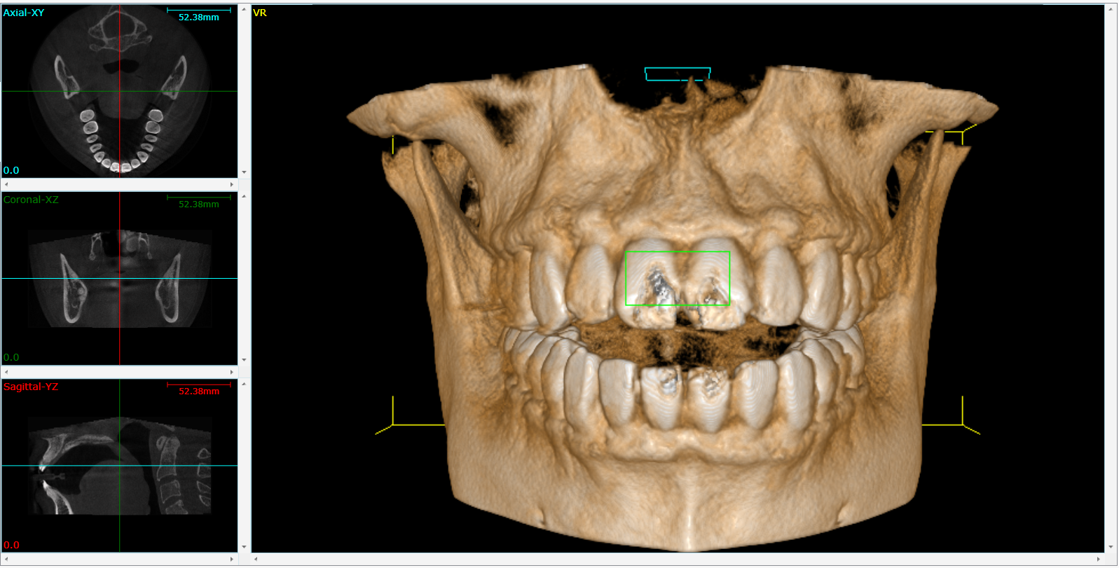 Dental CT scan showing a 3D render of the jaw and teeth with cross-sectional views on the left.