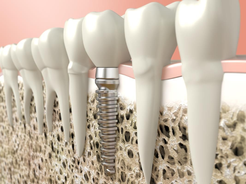 Dental implant anchored in jawbone beneath white teeth and pink gums