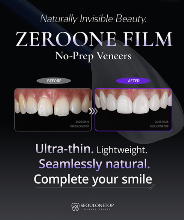 ZeroOne Film no-prep veneers: ultra-thin, lightweight and natural