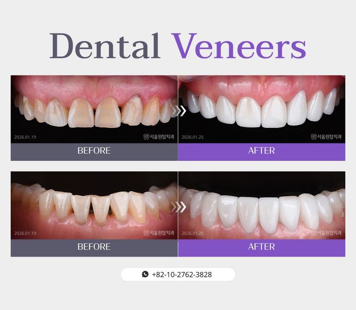 Dental veneers before and after, case 1