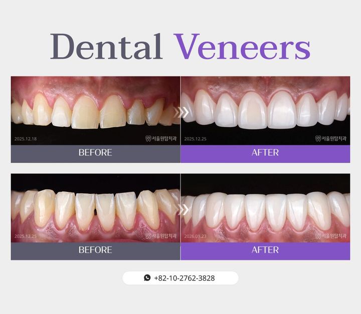 Dental veneers before and after, case 2