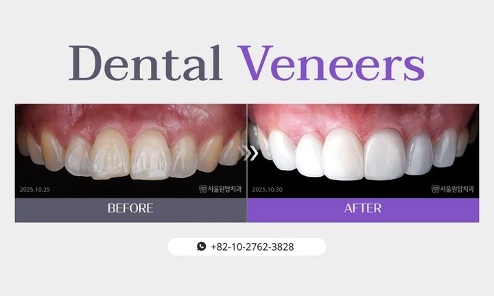 Dental veneers before and after, case 3