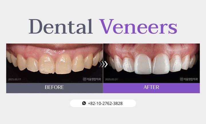 Dental veneers before and after, case 4