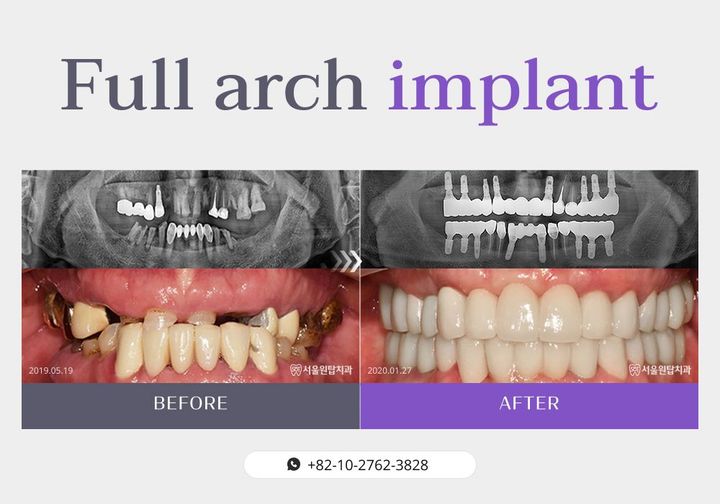 Full-arch implant before and after, case 1