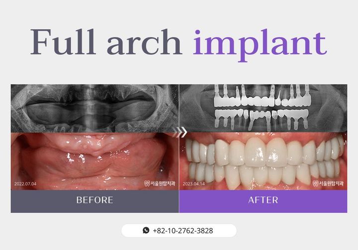 Full-arch implant before and after, case 2
