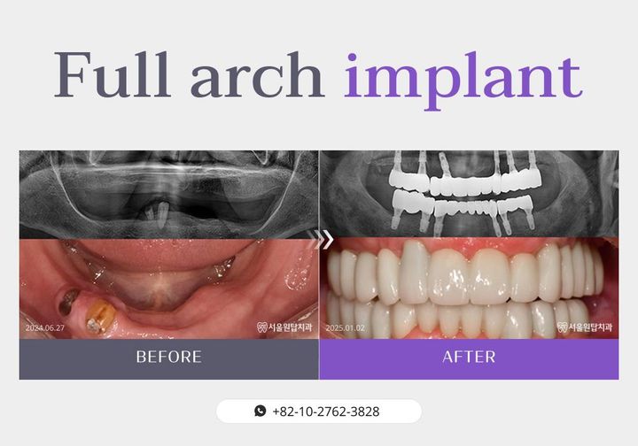 Full-arch implant before and after, case 3