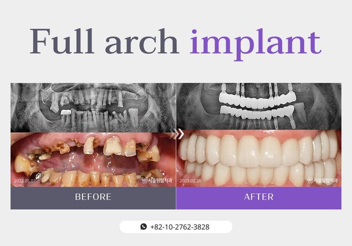 Full-arch implant before and after, case 4