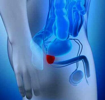 DR. RAÚL SIGFRIDO ROCHA ANAYA - Clínica de urología DR. RAÚL SIGFRIDO ROCHA ANAYA - Clínica de urología