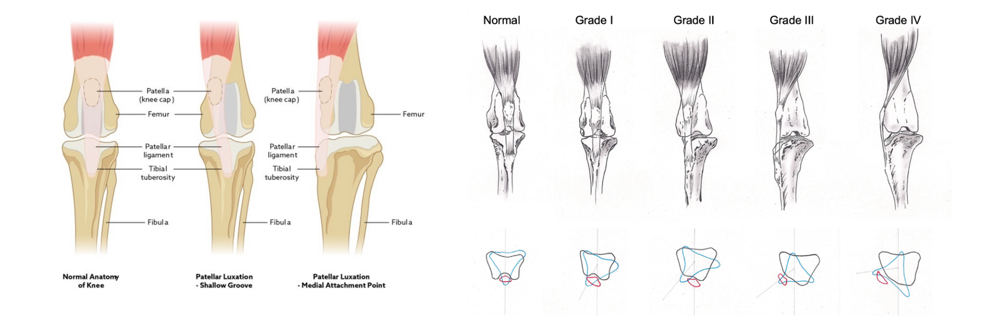 patellar luxation - shallow groove & medial attachment point
patellar luxation grades