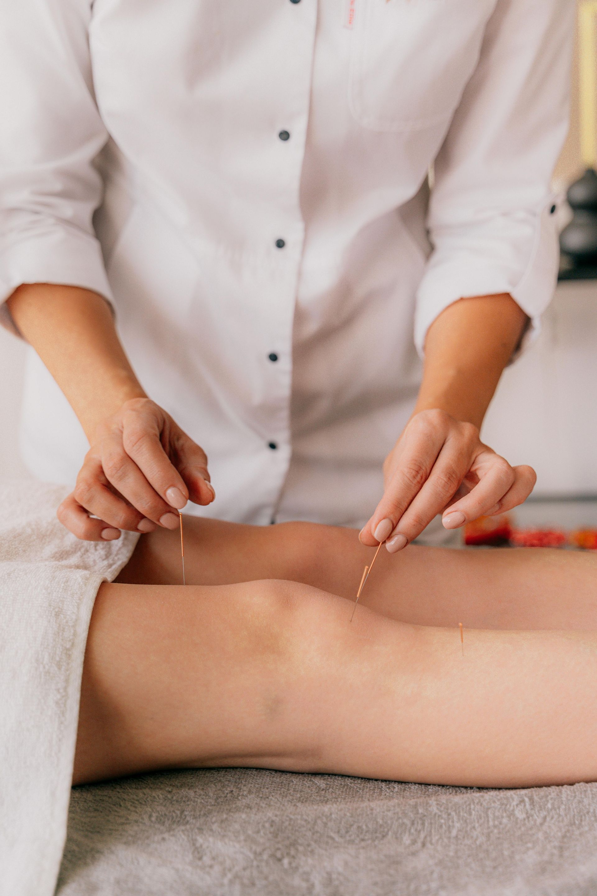 Image of acupuncture on human body