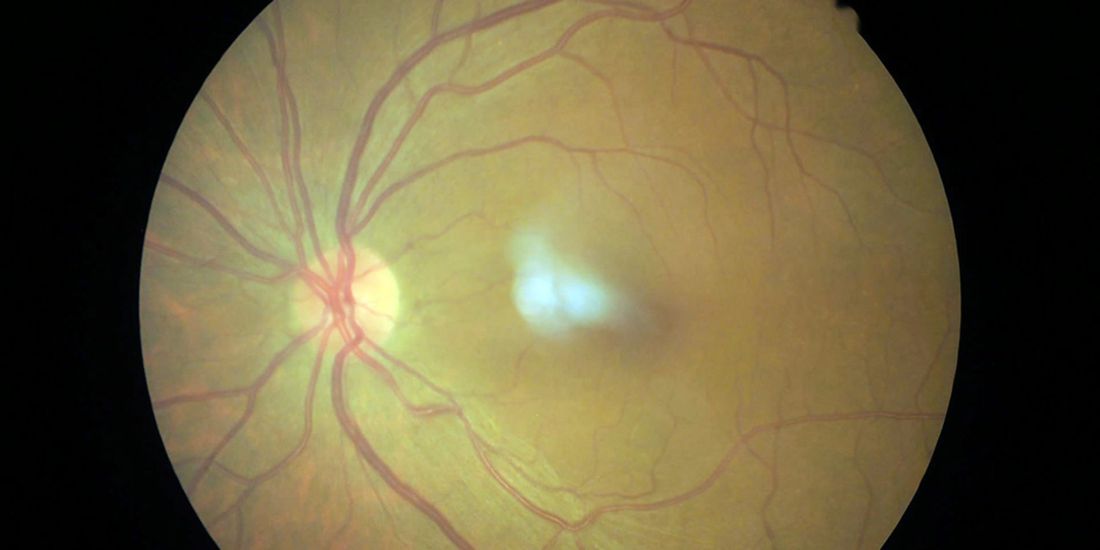 distacco retina
