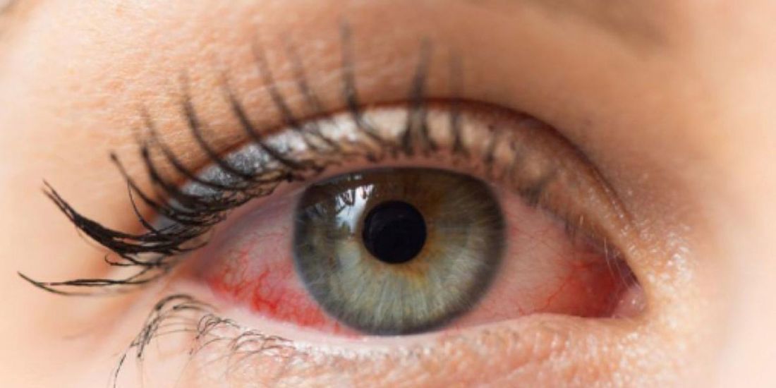 glaucoma