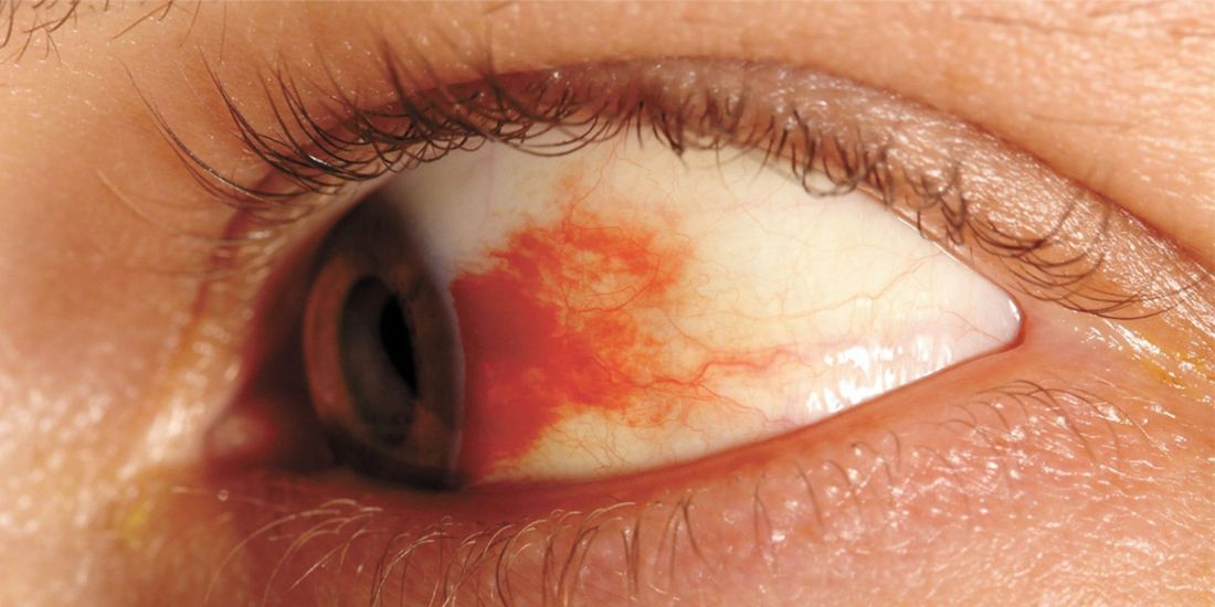 retinopatia diabetica