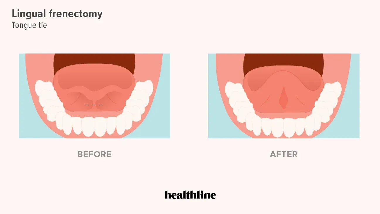 frenectomy Before and after