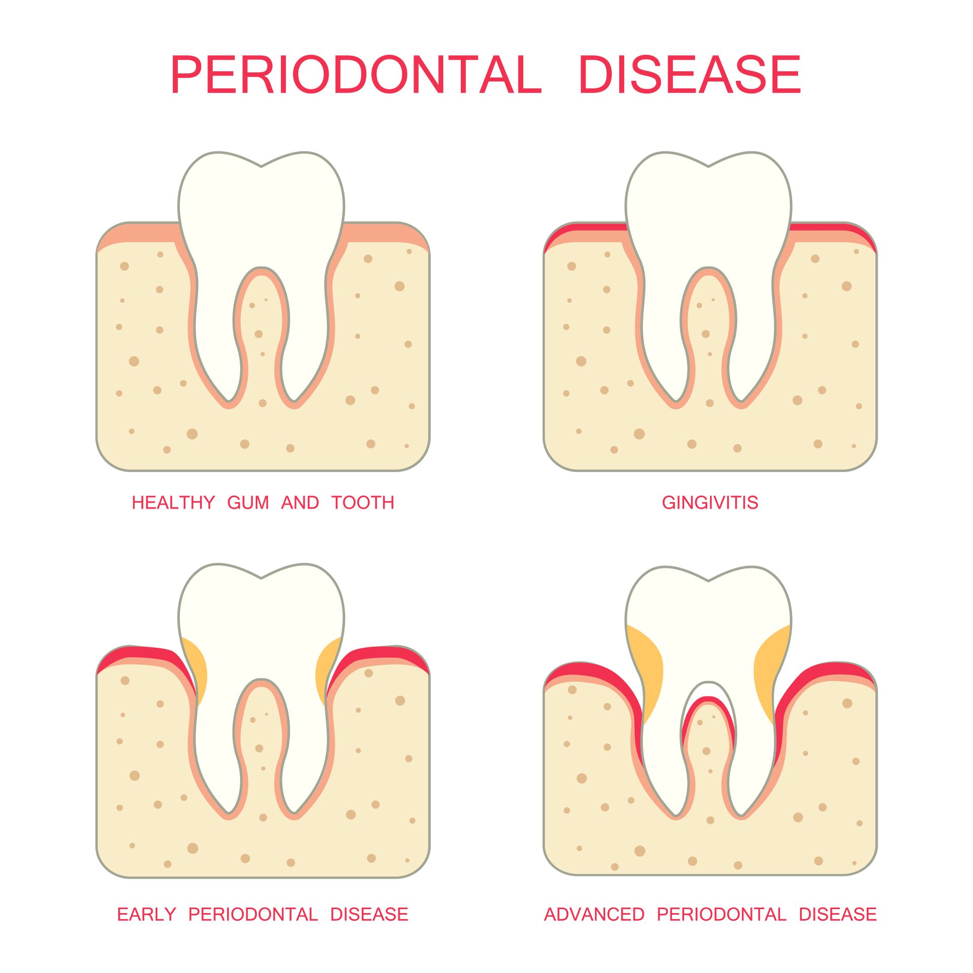 Fix gum disease with periodontal therapy | Corpus Christi TX periodontal treatment images | Best dentist for gum disease therapy in Corpus Christi TX