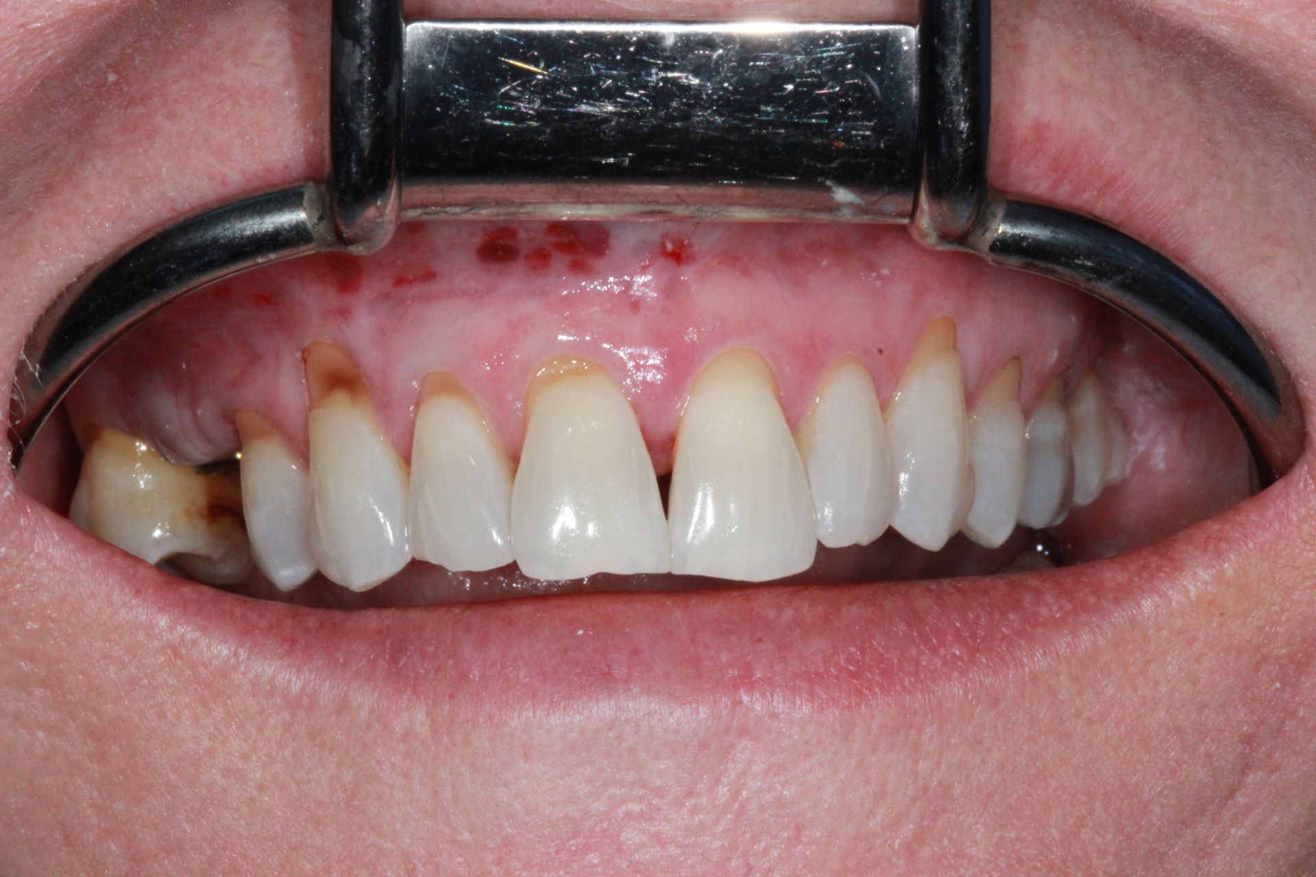 Before Gum Grafting