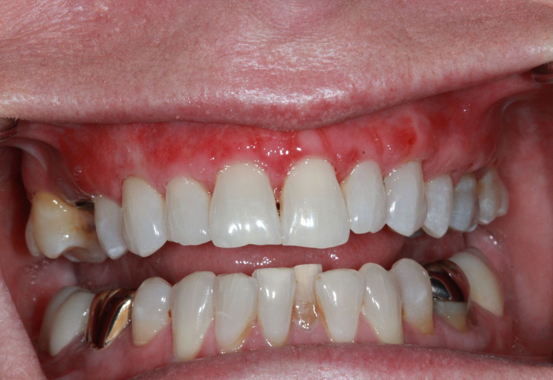 After Gum Grafting